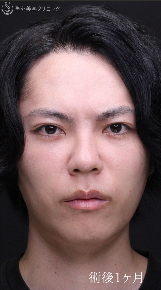 【30代男性・自然なクマの改善を】下眼瞼切開術/下眼瞼除皺術/ハムラ法（術後1ヶ月） After 