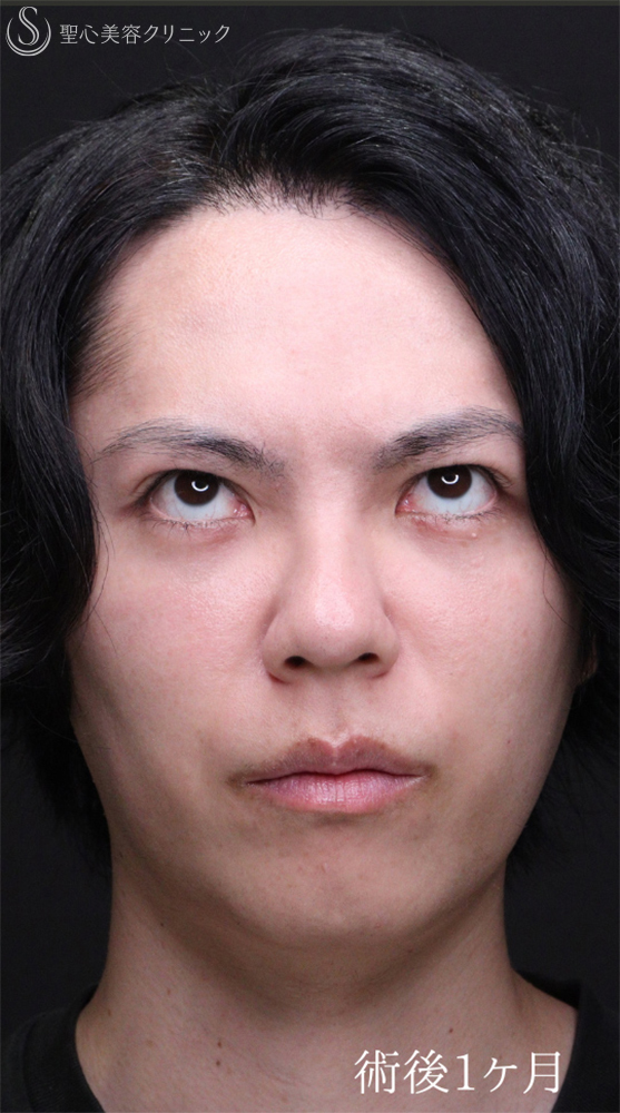 【30代男性・自然なクマの改善を】下眼瞼切開術/下眼瞼除皺術/ハムラ法（術後1ヶ月） After 