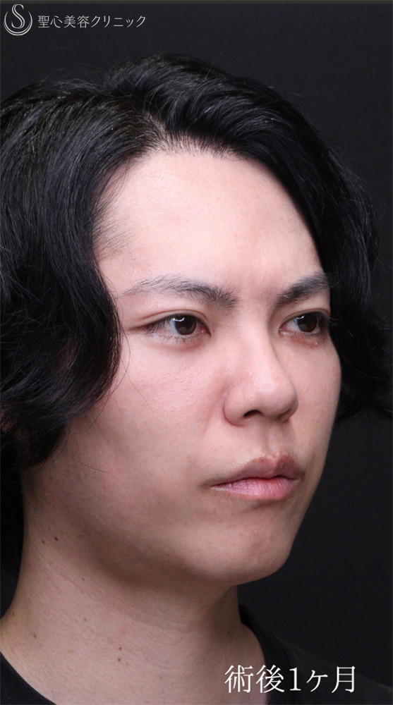 【30代男性・自然なクマの改善を】下眼瞼切開術/下眼瞼除皺術/ハムラ法（術後1ヶ月） After 