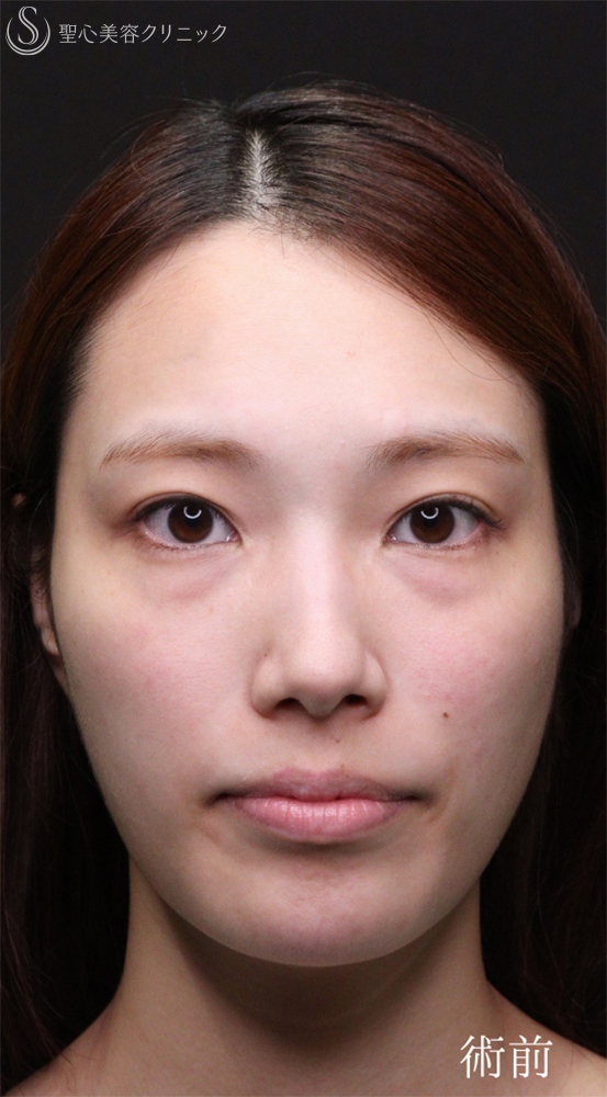 【20代女性・裏ハムラでクマを一掃】下眼瞼切開術/下眼瞼除皺術/ハムラ法（術後1〜３ヶ月） Before 