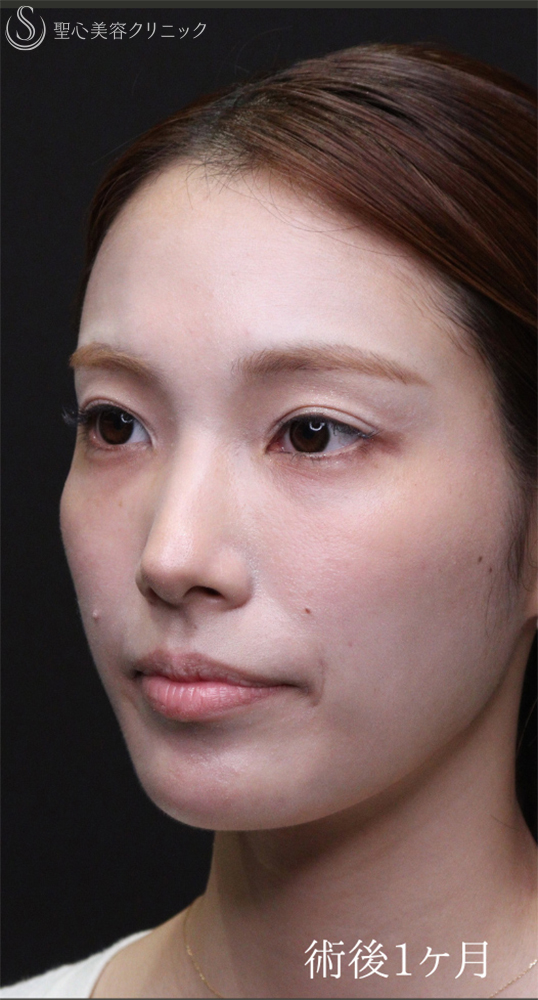 【20代女性・裏ハムラでクマを一掃】下眼瞼切開術/下眼瞼除皺術/ハムラ法（術後1〜３ヶ月） After 