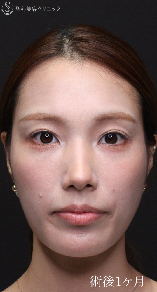 【20代女性・裏ハムラでクマを一掃】下眼瞼切開術/下眼瞼除皺術/ハムラ法（術後1〜３ヶ月） After 