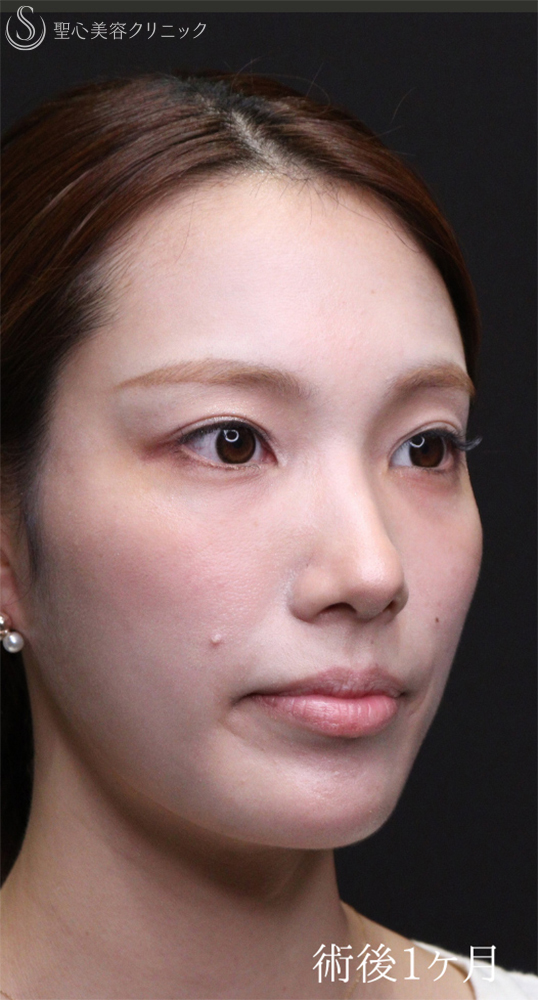 【20代女性・裏ハムラでクマを一掃】下眼瞼切開術/下眼瞼除皺術/ハムラ法（術後1〜３ヶ月） After 