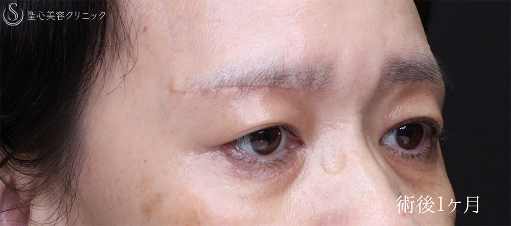 【50代女性・自然な目の開きを実現】眉下リフト（術後1ヶ月） After 