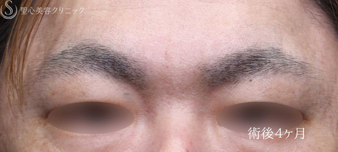 【40代男性・刻まれた眉間の皺を改善】プレミアムPRP皮膚再生療法（術後4ヶ月） After 