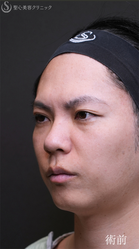 【30代男性・自然なクマの改善を】下眼瞼切開術/下眼瞼除皺術/ハムラ法（術後1ヶ月） Before 