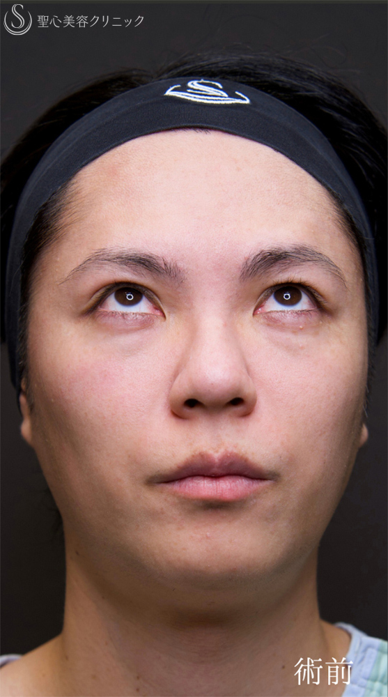 【30代男性・自然なクマの改善を】下眼瞼切開術/下眼瞼除皺術/ハムラ法（術後1ヶ月） Before 