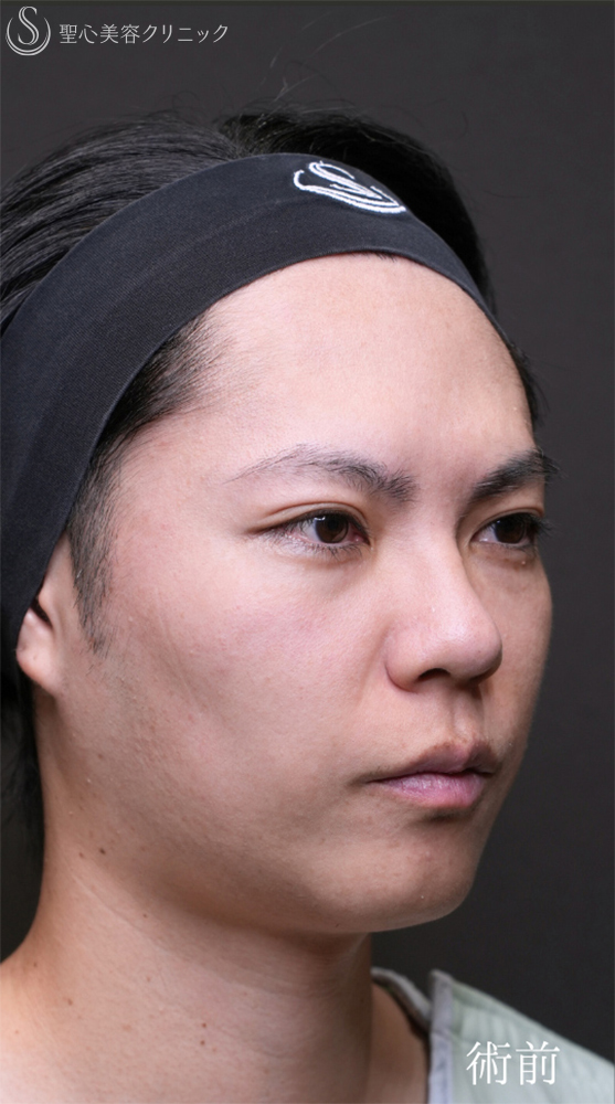 【30代男性・自然なクマの改善を】下眼瞼切開術/下眼瞼除皺術/ハムラ法（術後1ヶ月） Before 