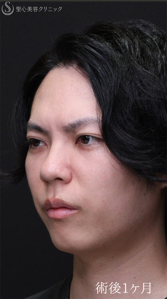 【30代男性・自然なクマの改善を】下眼瞼切開術/下眼瞼除皺術/ハムラ法（術後1ヶ月） After 