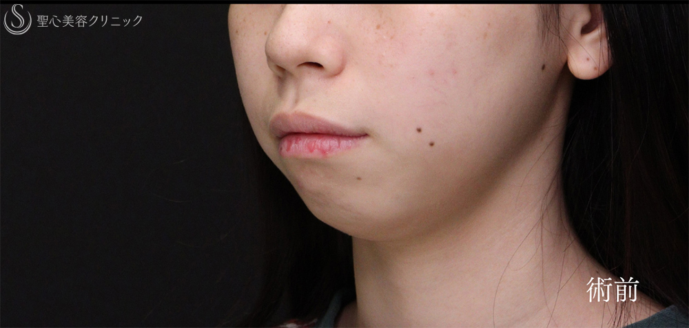 【20代女性・Eラインを整えることで輪郭を激変】あごプロテーゼ（術後1ヶ月～3ヶ月） Before 