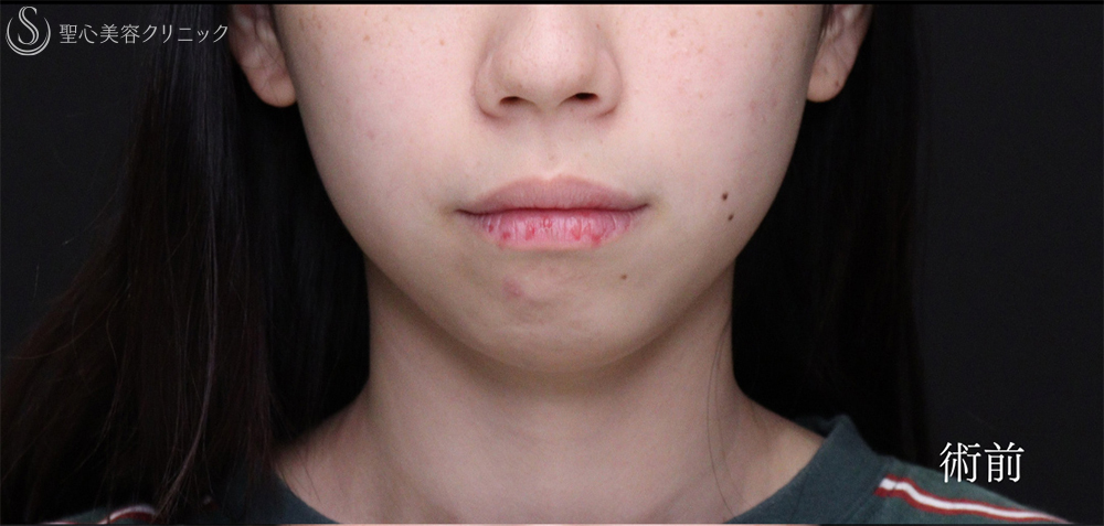【20代女性・Eラインを整えることで輪郭を激変】あごプロテーゼ（術後1ヶ月～3ヶ月） Before 