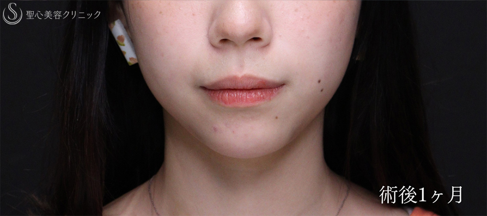 【20代女性・Eラインを整えることで輪郭を激変】あごプロテーゼ（術後1ヶ月～3ヶ月） After 