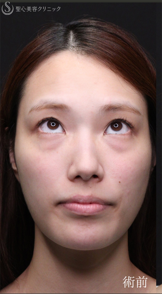 【20代女性・裏ハムラでクマを一掃】下眼瞼切開術/下眼瞼除皺術/ハムラ法（術後1〜３ヶ月） Before 
