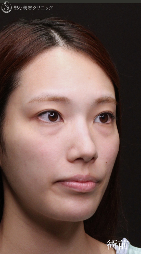 【20代女性・裏ハムラでクマを一掃】下眼瞼切開術/下眼瞼除皺術/ハムラ法（術後1〜３ヶ月） Before 