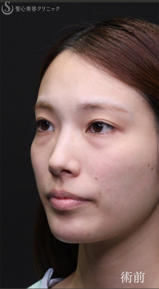 【20代女性・裏ハムラでクマを一掃】下眼瞼切開術/下眼瞼除皺術/ハムラ法（術後1〜３ヶ月） Before 