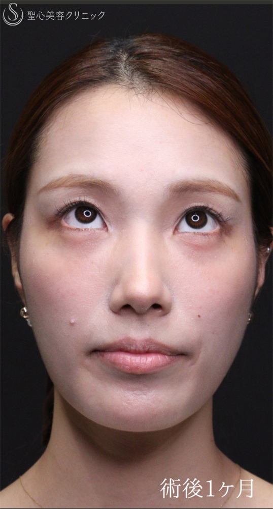 【20代女性・裏ハムラでクマを一掃】下眼瞼切開術/下眼瞼除皺術/ハムラ法（術後1〜３ヶ月） After 