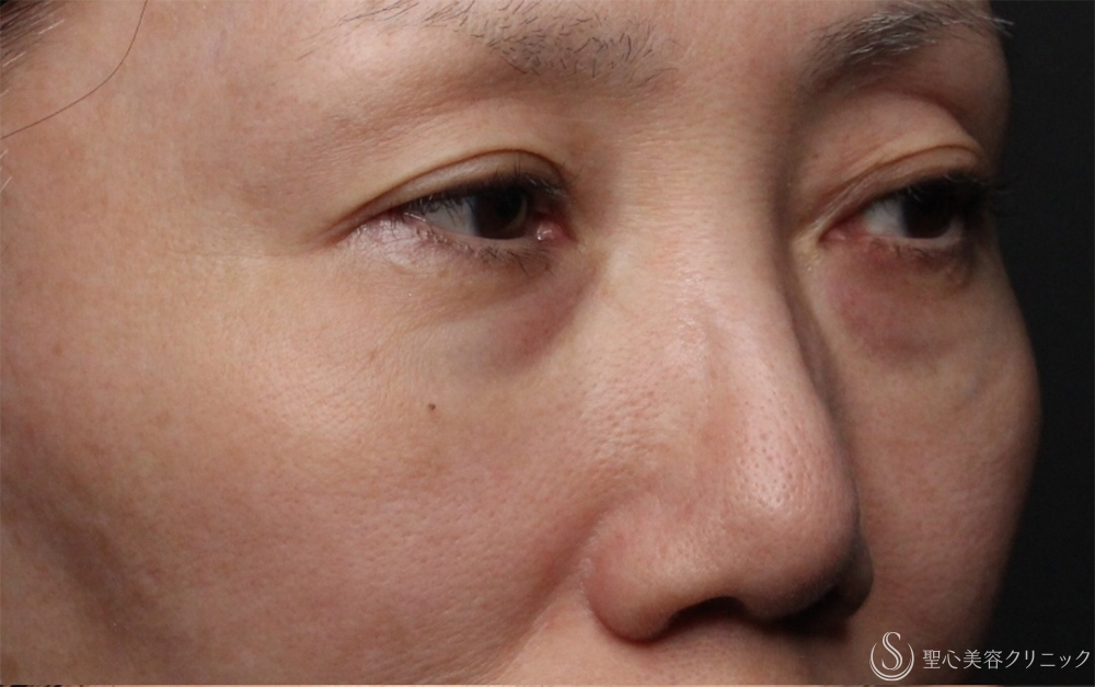 【50代女性・切らないクマ取り】目の下の脂肪取り（経結膜下脱脂法）（1ヶ月後） Before 