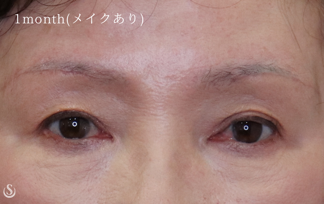 【60代女性・目元の若々しさを】眉下切開法（眉下リフト）（術後翌日～術後3ヶ月） After 