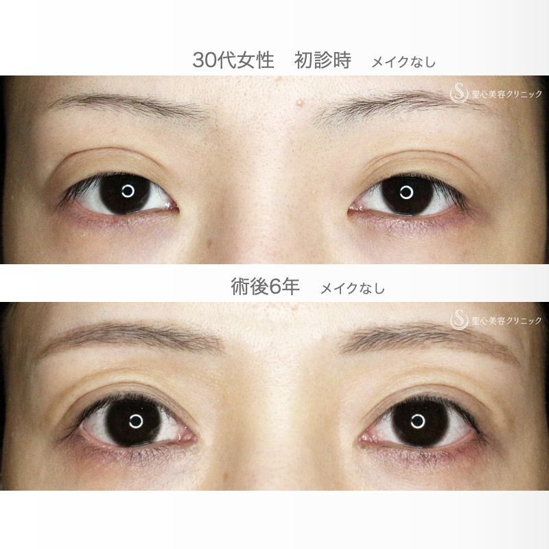【30代女性・広すぎる二重の他院修正例】二重全切開+α法＆目頭切開→癒着による凹み目にヒアルロン酸（6年後） After 