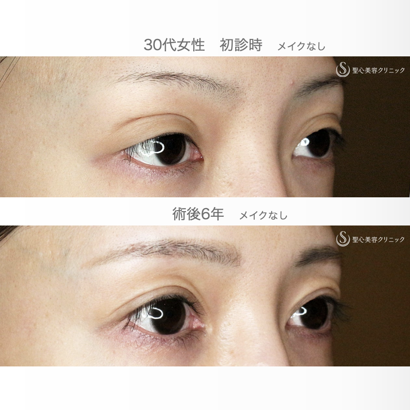 【30代女性・広すぎる二重の他院修正例】二重全切開+α法＆目頭切開→癒着による凹み目にヒアルロン酸（6年後） After 
