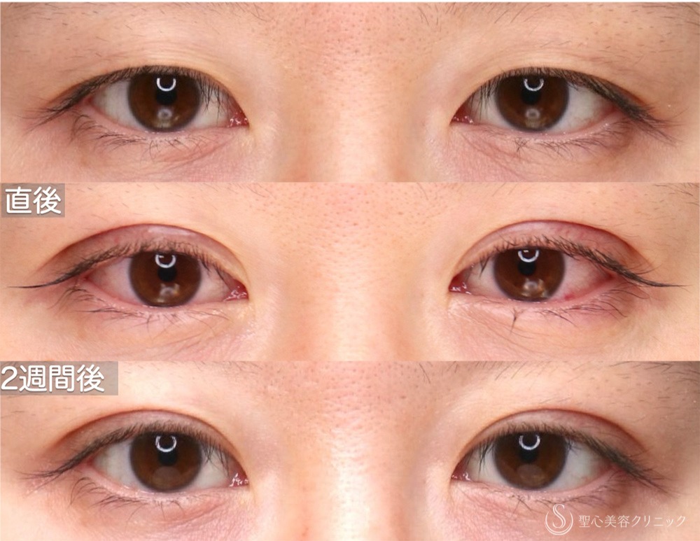 施術当日〜翌日〜1週間後〜2週間後