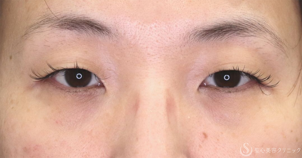 【40代女性・たるみを改善し理想の二重へ】二重術（埋没法）：マイクロメソッド+α（1ヶ月後） Before 