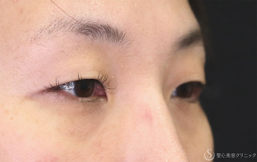【40代女性・たるみを改善し理想の二重へ】二重術（埋没法）：マイクロメソッド+α（1ヶ月後） Before 