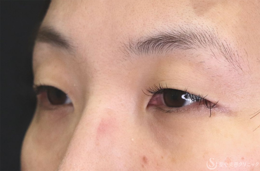 【40代女性・たるみを改善し理想の二重へ】二重術（埋没法）：マイクロメソッド+α（1ヶ月後） Before 