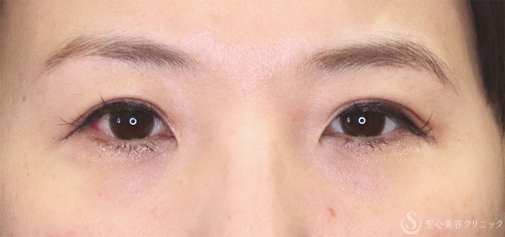 【40代女性・たるみを改善し理想の二重へ】二重術（埋没法）：マイクロメソッド+α（1ヶ月後） After 