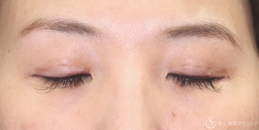 【40代女性・たるみを改善し理想の二重へ】二重術（埋没法）：マイクロメソッド+α（1ヶ月後） After 