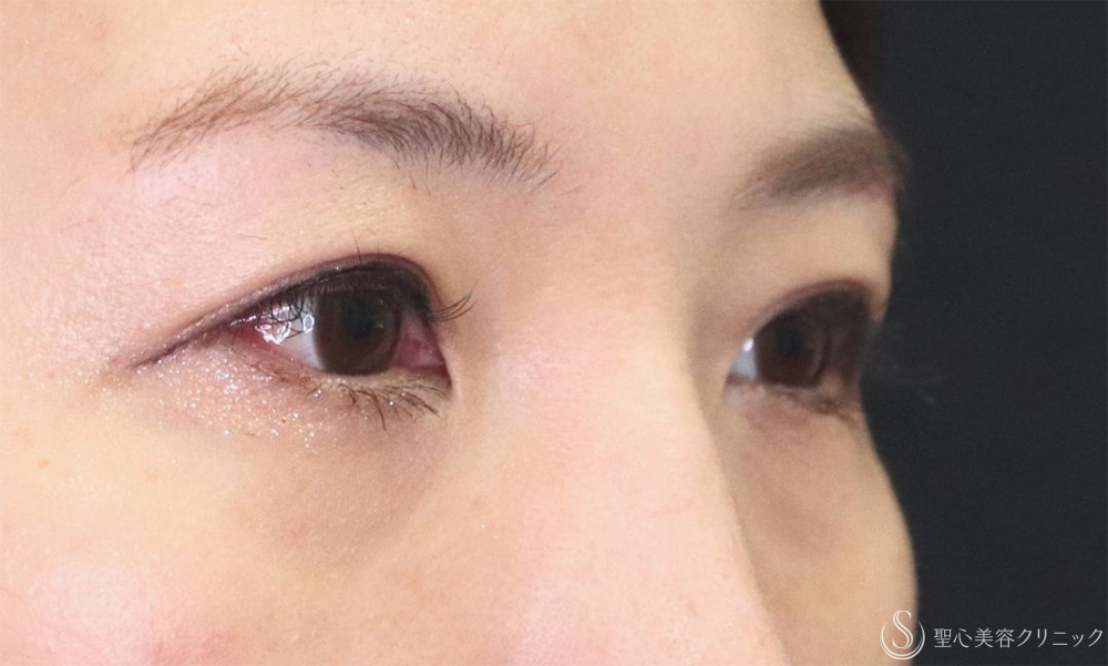 【40代女性・たるみを改善し理想の二重へ】二重術（埋没法）：マイクロメソッド+α（1ヶ月後） After 