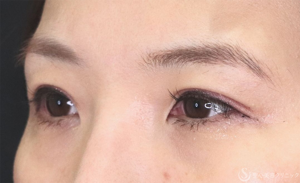 【40代女性・たるみを改善し理想の二重へ】二重術（埋没法）：マイクロメソッド+α（1ヶ月後） After 