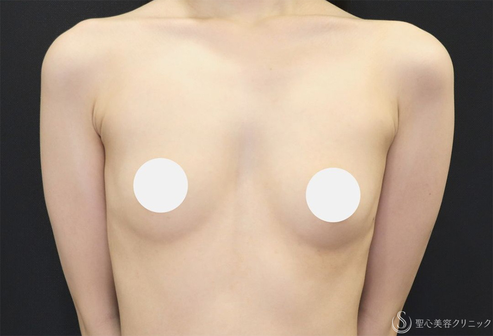 【20代女性・ふっくらと自然なバストへ】ハイブリッド（コンポジット）豊胸術（1ヶ月後） Before 