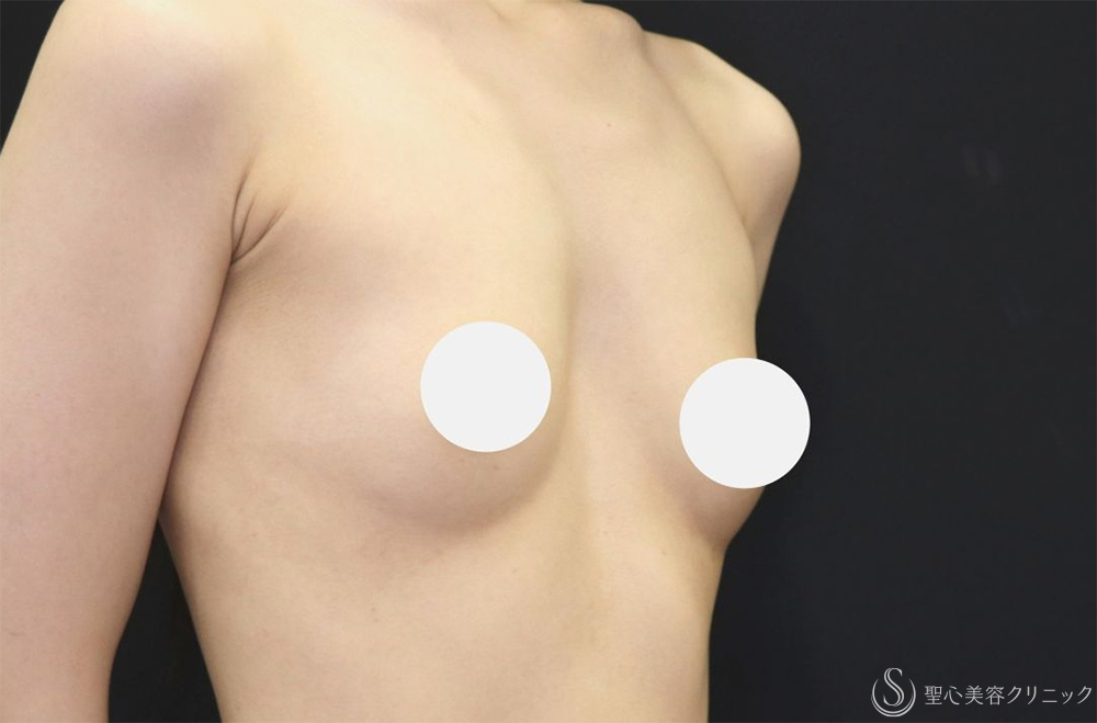 【20代女性・ふっくらと自然なバストへ】ハイブリッド（コンポジット）豊胸術（1ヶ月後） Before 