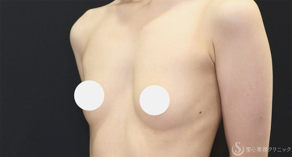 【20代女性・ふっくらと自然なバストへ】ハイブリッド（コンポジット）豊胸術（1ヶ月後） Before 