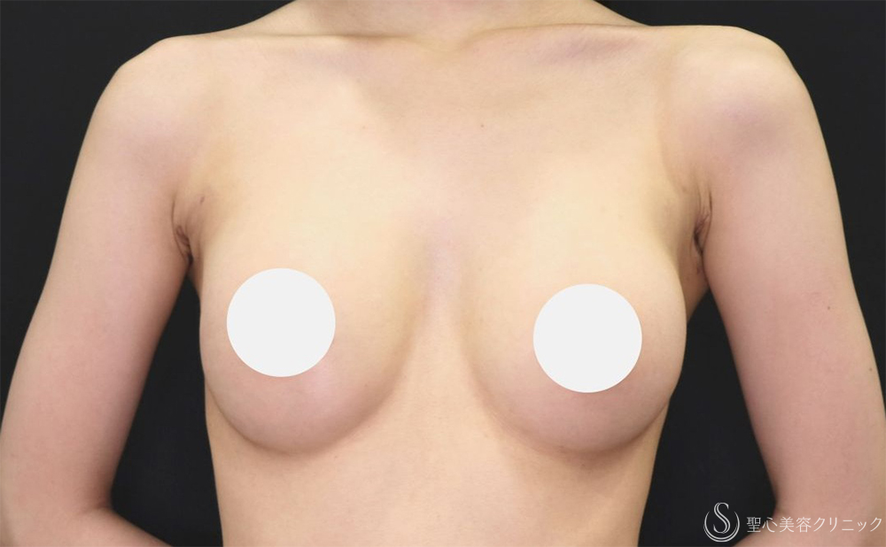 【20代女性・ふっくらと自然なバストへ】ハイブリッド（コンポジット）豊胸術（1ヶ月後） After 