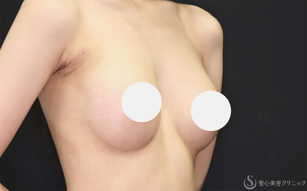 【20代女性・ふっくらと自然なバストへ】ハイブリッド（コンポジット）豊胸術（1ヶ月後） After 