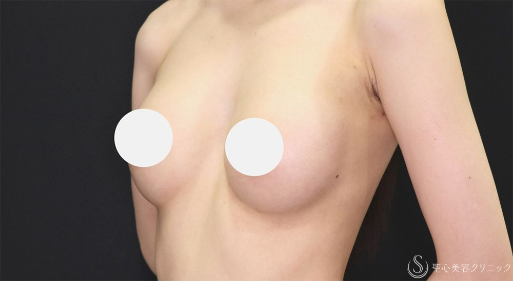 【20代女性・ふっくらと自然なバストへ】ハイブリッド（コンポジット）豊胸術（1ヶ月後） After 