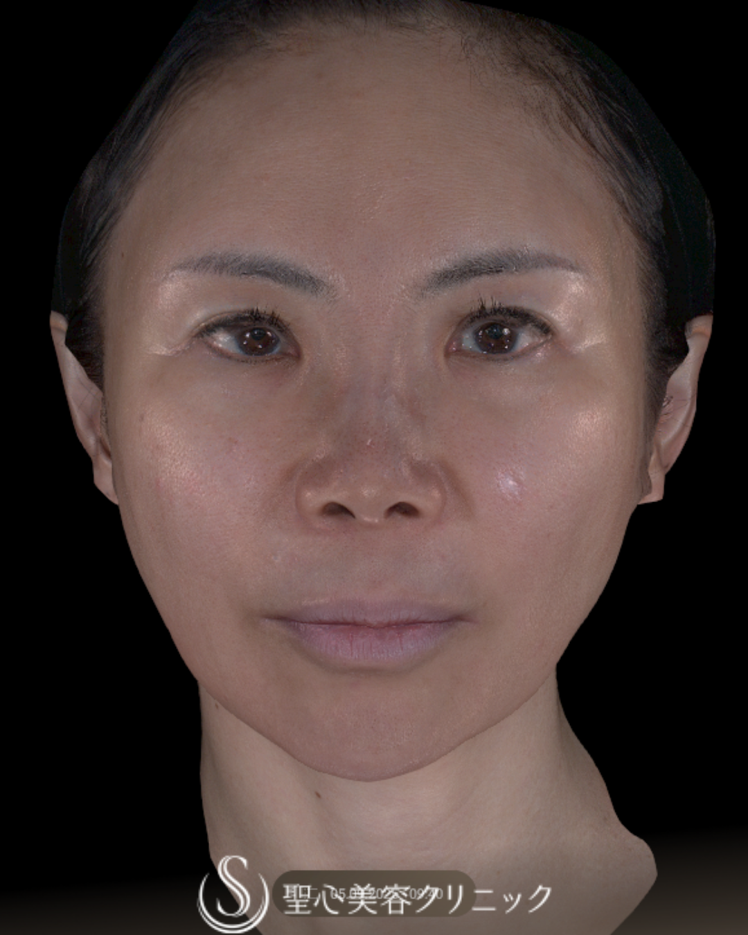 【50代女性・こけずに小顔】ボトックスリフト＋ワンダーフェイスプロ（4週間後） Before 