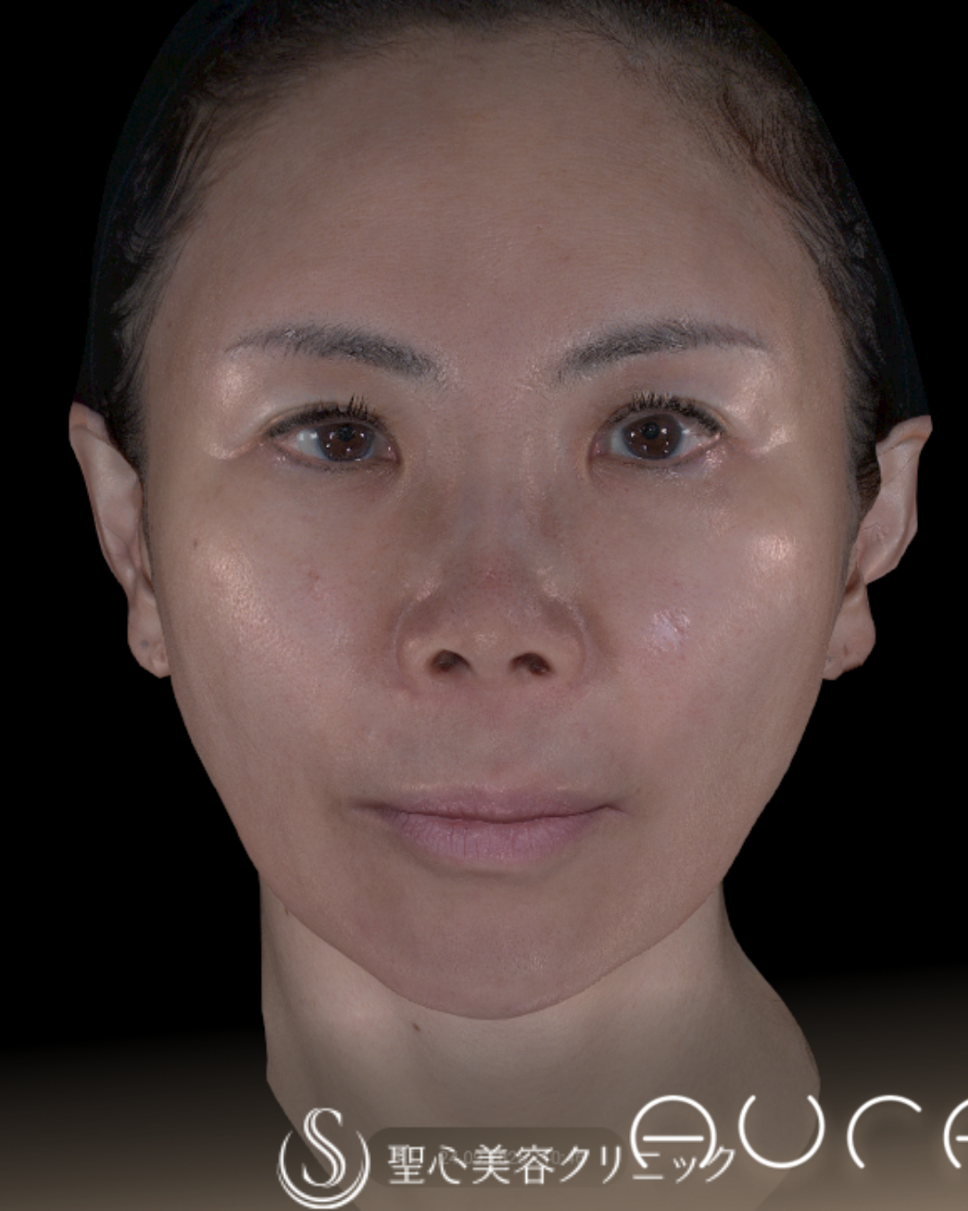 【50代女性・こけずに小顔】ボトックスリフト＋ワンダーフェイスプロ（4週間後） After 