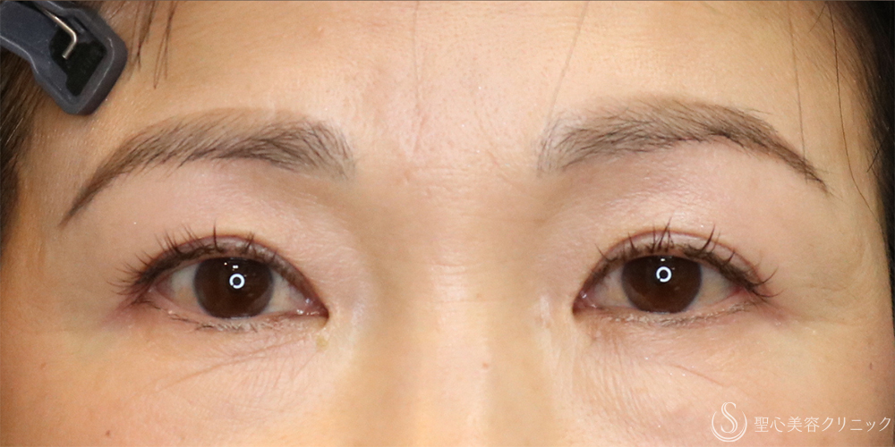 【50代女性・まぶたスッキリ】眉下切開＋目上切開（1年後） After 