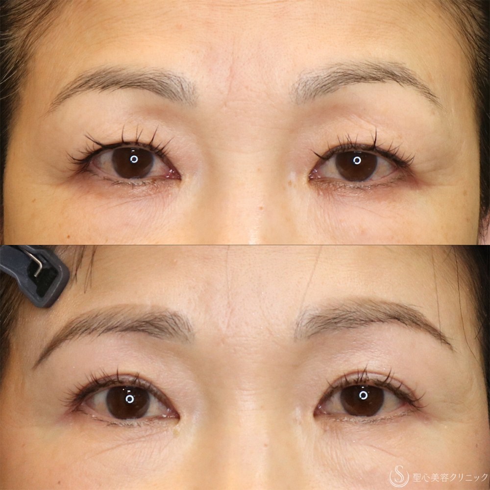 【50代女性・まぶたスッキリ】眉下切開＋目上切開（1年後） After 名古屋+まぶたのタルミ取り・二重・ぱっちり二重・眉下切開