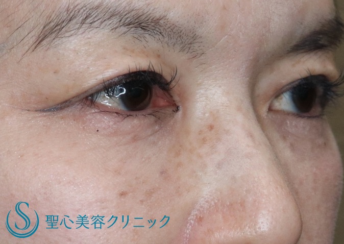 【40代女性・華やかな二重に若返り】二重全切開（術後6ヶ月） After 