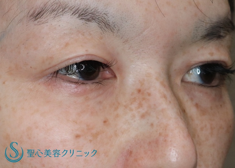 【40代女性・華やかな二重に若返り】二重全切開（術後6ヶ月） Before 