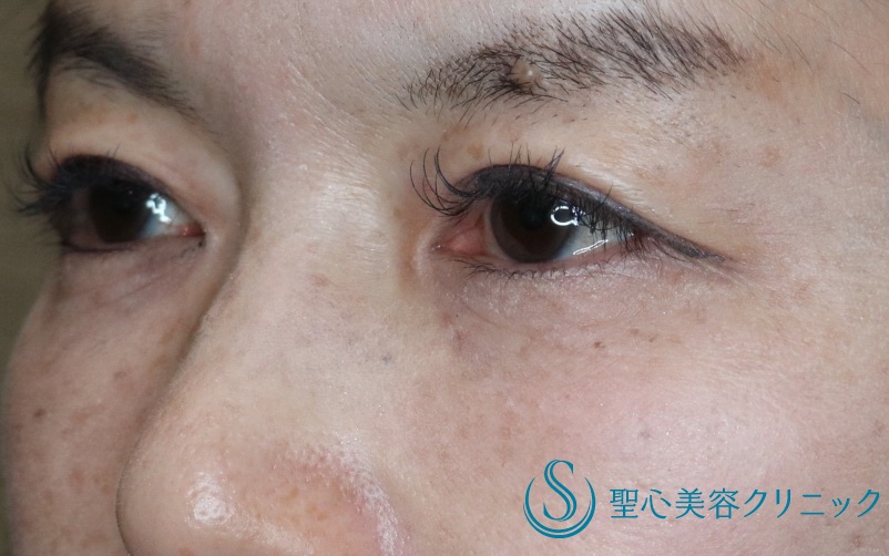【40代女性・華やかな二重に若返り】二重全切開（術後6ヶ月） After 