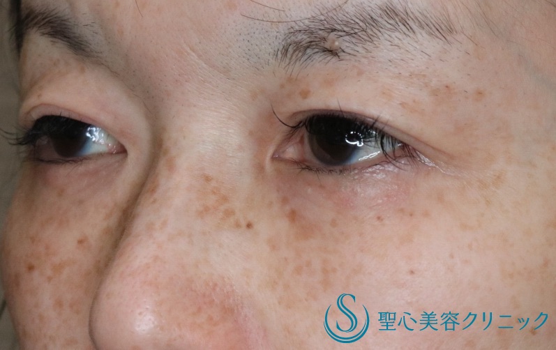 【40代女性・華やかな二重に若返り】二重全切開（術後6ヶ月） Before 