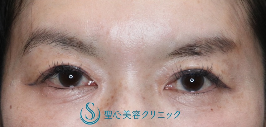 【40代女性・華やかな二重に若返り】二重全切開（術後6ヶ月） After 