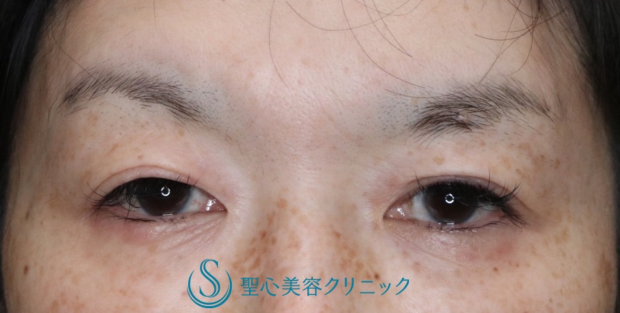 【40代女性・華やかな二重に若返り】二重全切開（術後6ヶ月） Before 