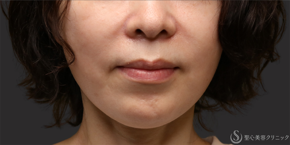 【50代女性・注射で長期的に改善】プレミアムPRP皮膚再生療法（ほうれい線）（6ヶ月後） After 