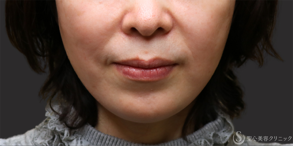 【50代女性・注射で長期的に改善】プレミアムPRP皮膚再生療法（ほうれい線）（6ヶ月後） Before 